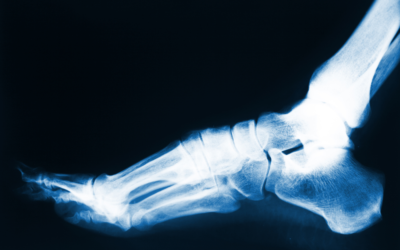 Do I Really Need Foot Surgery? Reasons Why Surgery Might Be Recommended