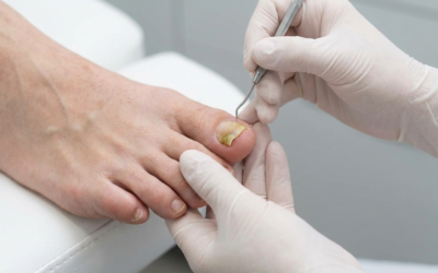 Fungal Toenails in Abbotsford: The Unseen Health Threat Costing You More Than Money